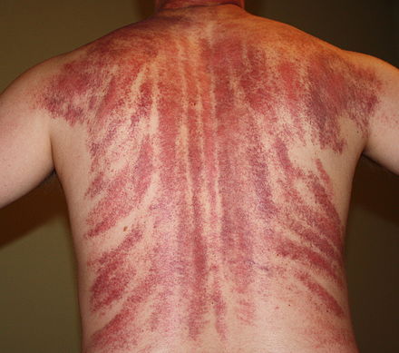 Gua Sha : Technique populaire chinoise, ou vraie médecine ?